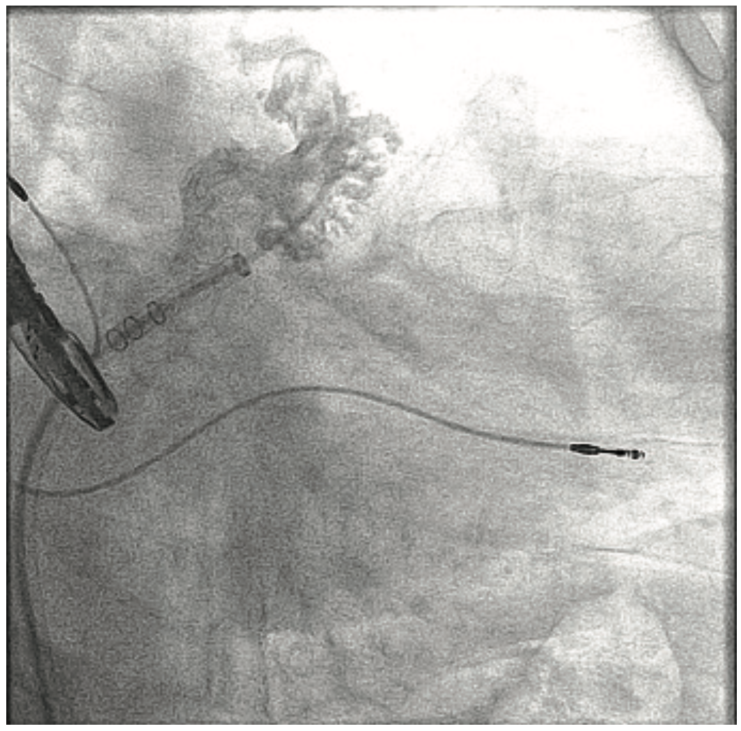 Use of the ACIST CVi System in Structural Heart Interventions